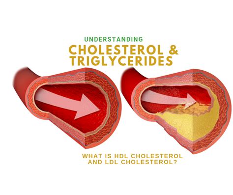 Cholesterol Triglyceride Hdl Ldl - A Pictures Of Hole 2018