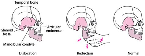 Jaw Dislocation - Mouth and Dental Disorders - Merck Manuals Consumer ...