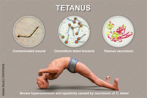 Tetanus disease, opisthotonus in a man suffering from tetanus Stock ...