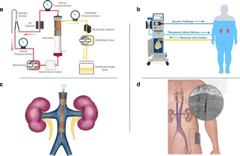 Medical Treatment Fluid Overload at Bobby Garay blog