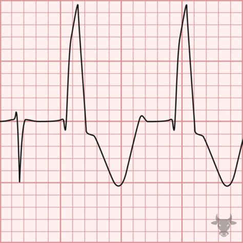 Ashman Phenomenon | ECG Stampede