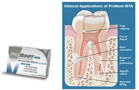 Dental Trauma Part I: Infraction, Crown Fractures & Vital Pulp TherapyTri-City Dev