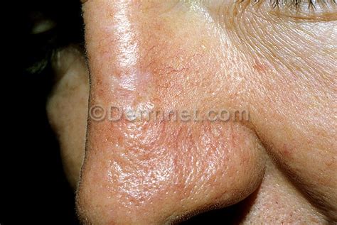 Basal Cell Carcinoma Nose Basal Cell Carcinoma Pictures & Images ...