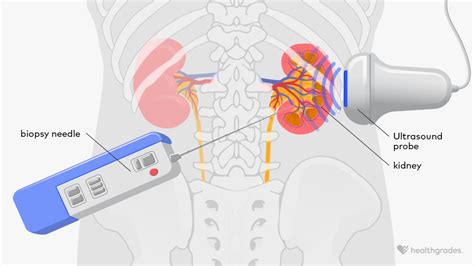 Kidney Biopsy: Purpose, Procedure, and What to Expect