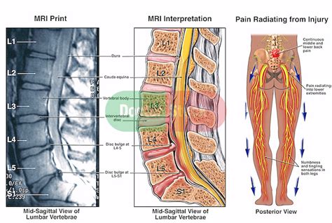 Low Back Pain - L4-5 and L5-S1 Lumbar Injuries | Doctor Stock