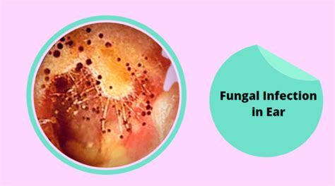 Fungal Infection in Ear Canal - Causes - 7 Best Home Remedy