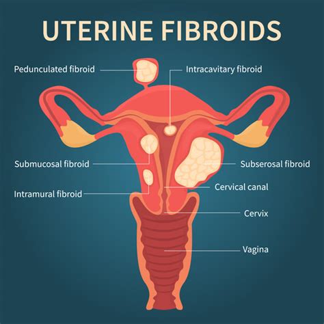 Uterine Fibroids FAQs - Manhattan Reproductive Surgery Center, NY