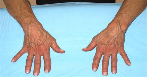 Sudden bulging veins in hands: Causes, symptoms, and treatment