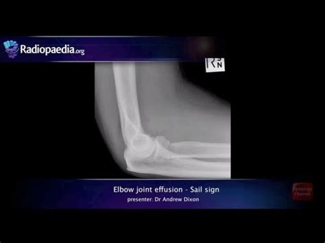 Elbow joint effusion and the sail sign - radiology video tutorial (x ...