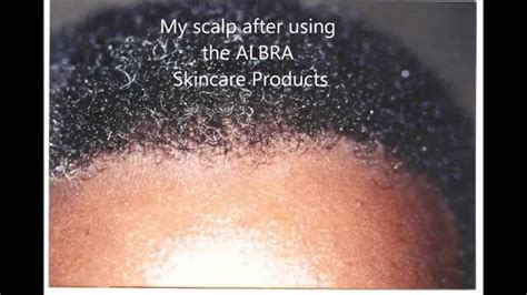 Seborrheic Dermatitis Hair Loss | Galhairs