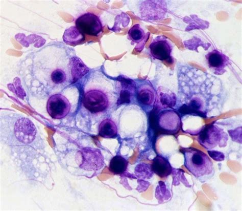 Cryptococcus and pyogranulomatous inflammation in nasal discharge from a cat. The Cryptococcus ...