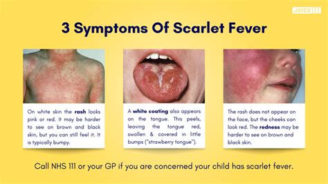 Scarlet Fever Rash Face