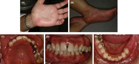 Titanium Implants Side Effects