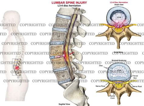 L3-4 Lumbar spine disc herniation - Male — Medical Art Works