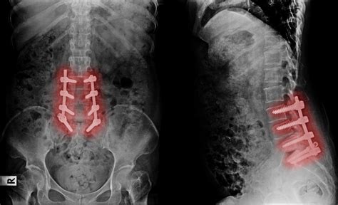 Nerve Decompression Surgery | DokiLink