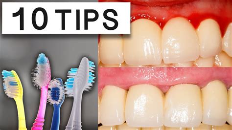10 Tips To Reduce Swollen Gums At Home - YouTube