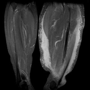 Coronal MRI view of soft tissue swelling of left lower limb. | Download ...