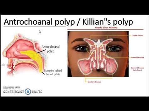 Antrochoanal polyp lecture / Nasal polyp S.P medical college - YouTube