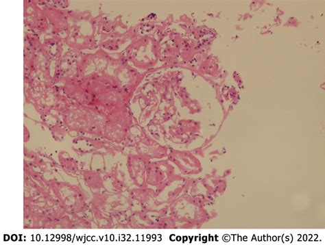 Renal biopsy results. | Download Scientific Diagram