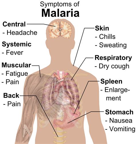 File:Symptoms of Malaria.png - Wikipedia