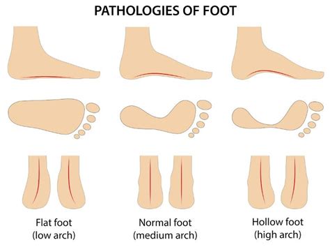 Flat Feet vs High Arch