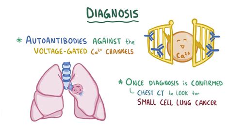 Lambert-Eaton myasthenic syndrome: Video & Anatomy | Osmosis