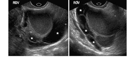 Transvaginal ultrasound images showing typical features of a right ...