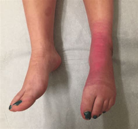 Case 1 with left lower extremity CRPS type-1 and contracture of the... | Download Scientific Diagram