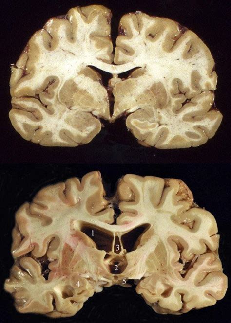 A normal human brain (top) vs the brain of a retired football player (bottom) : r/interestingasfuck