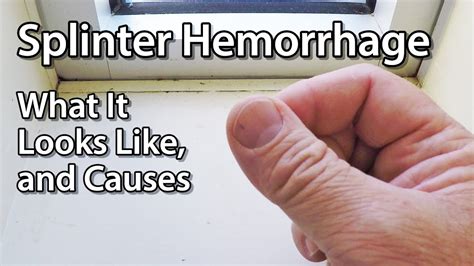 Splinter Hemorrhage - What It Looks Like, and Causes - YouTube