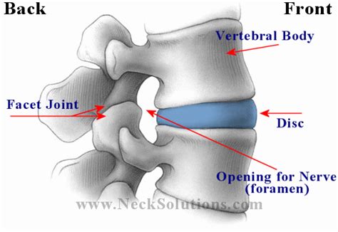 Back Herniated Disc - What Is It & Ways To Help Pain Relief