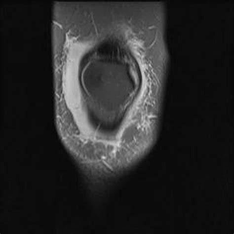 Bursitis MRI - wikidoc