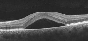 How to read OCTs: 8 fundamental diseases - EyeGuru