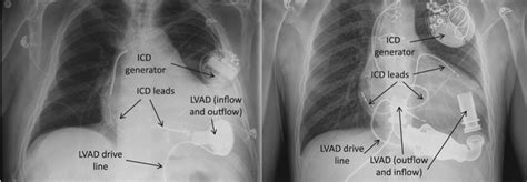 Left Ventricular Assist Device (LVAD) — BROWN EMERGENCY MEDICINE