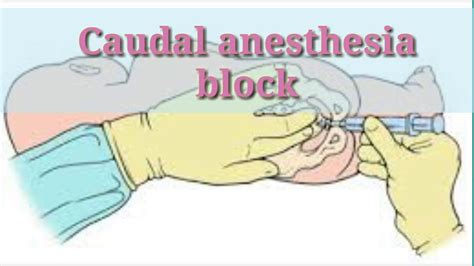 Caudal Anesthesia Technique