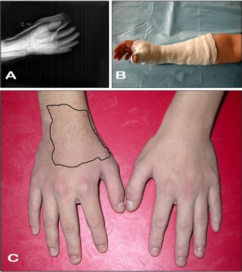 (A) X-ray examination showed that the fractured first metacarpus of... | Download Scientific Diagram