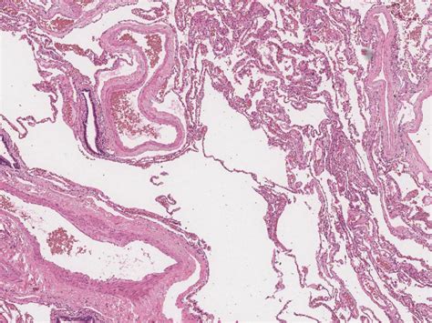 Bronchiectasis Histology