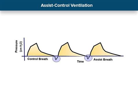 Best Practices Ventilator Management | Free Hot Nude Porn Pic Gallery