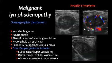 Pin on lymphatics | Diagnostic medical sonography, Nuclear medicine, Sonography