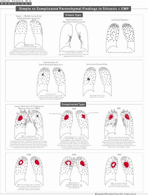 Silicosis Diagrams - Breader