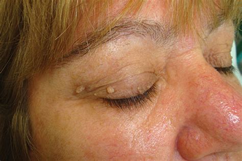 Photos of Skin Tags on Eyelids ~ How To Remove Moles, Warts, Skin Tags Safely