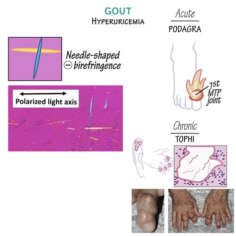 Gout Vs Pseudogout Crystals