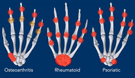 Osteoarthritis Vs Rheumatoid Arthritis Hands