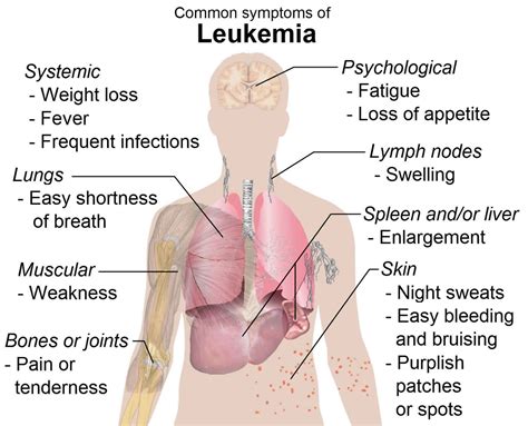 Myelogenous leukemia, acute, chronic, symptoms, diagnosis & treatment