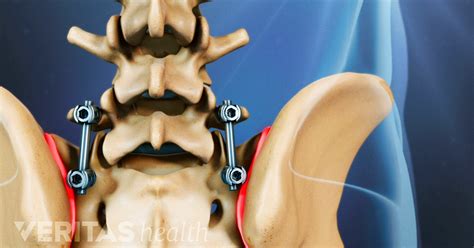 Is Lumbar Fusion Surgery a Reliable Procedure?