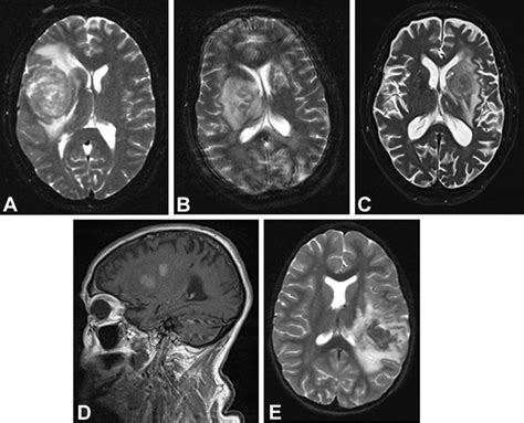 Tumefactive MS is a variant of MS (A) that can easily be mistaken for ...