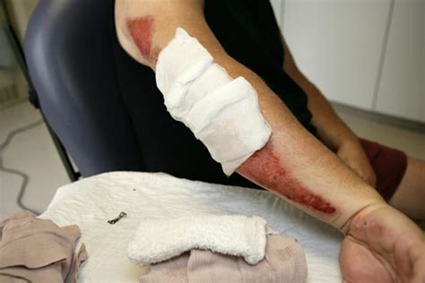 What is Road Rash? - Mattiacci Law, LLC