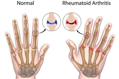 6 Types Of Arthritis: Which Is The Most Common? | Morada Senior Living