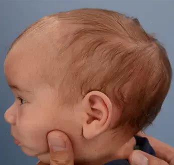 Navigating your child's diagnosis of Craniosynostosis