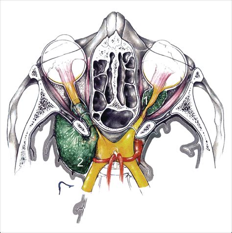 Optic Nerve Sheath Meningiomas in Patients With Neurofibromatosis Type 2 | Congenital Defects ...